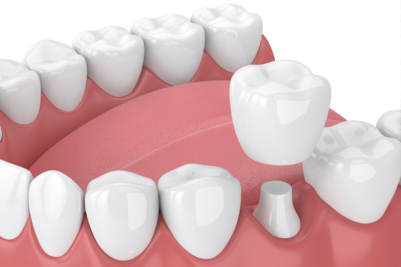 Dental Crowns in Los Altos