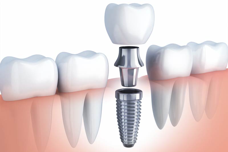Implants Dentist in Los Altos